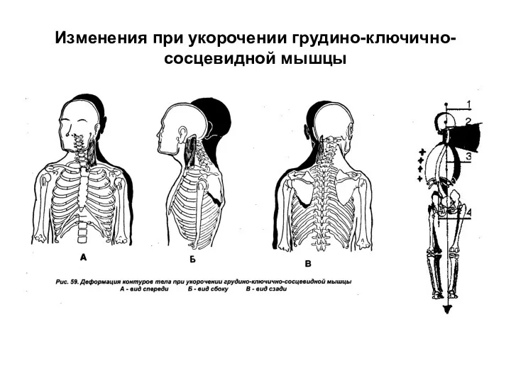 Изменения при укорочении грудино-ключично-сосцевидной мышцы