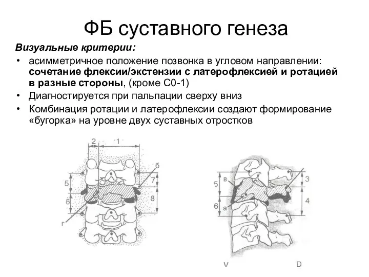 ФБ суставного генеза Визуальные критерии: асимметричное положение позвонка в угловом