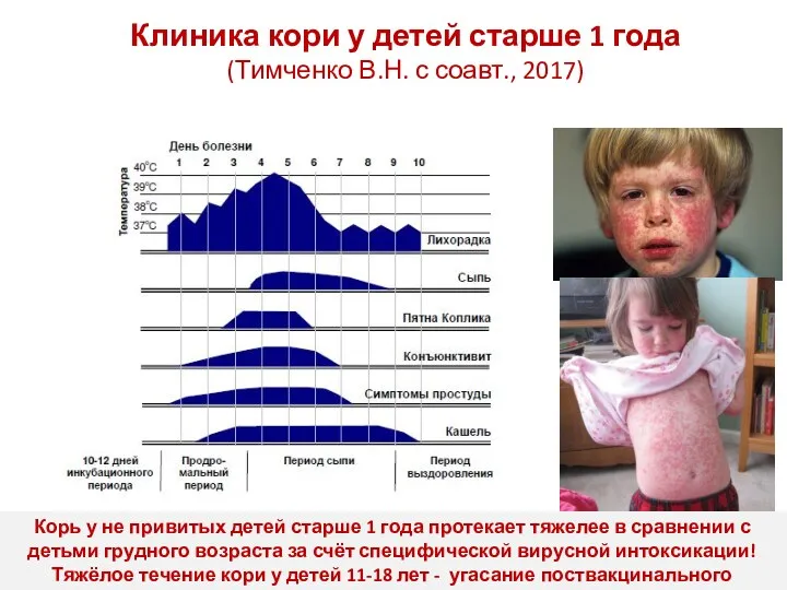 Клиника кори у детей старше 1 года (Тимченко В.Н. с