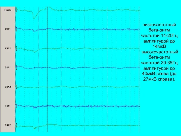 низкочастотный бета-ритм частотой 14-20Гц амплитудой до 14мкВ высокочастотный бета-ритм частотой