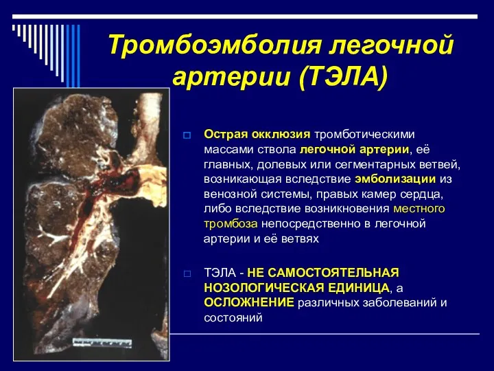 Тромбоэмболия легочной артерии (ТЭЛА) Острая окклюзия тромботическими массами ствола легочной артерии, её главных,