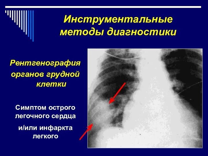 Инструментальные методы диагностики Рентгенография органов грудной клетки Симптом острого легочного сердца и/или инфаркта легкого