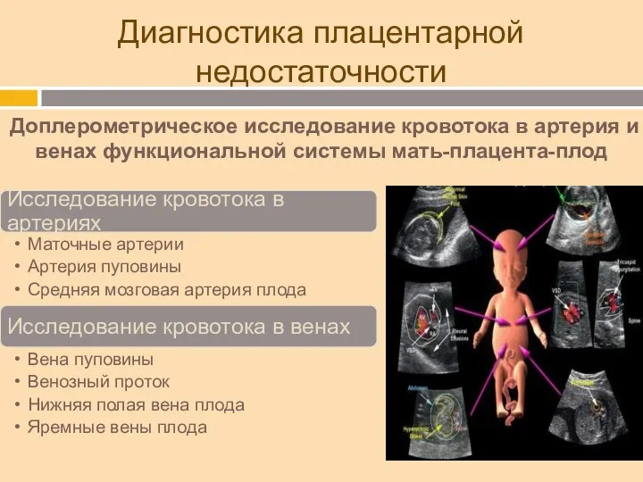 Диагностика плацентарной недостаточности Доплерометрическое исследование кровотока в артерия и венах функциональной системы мать-плацента-плод