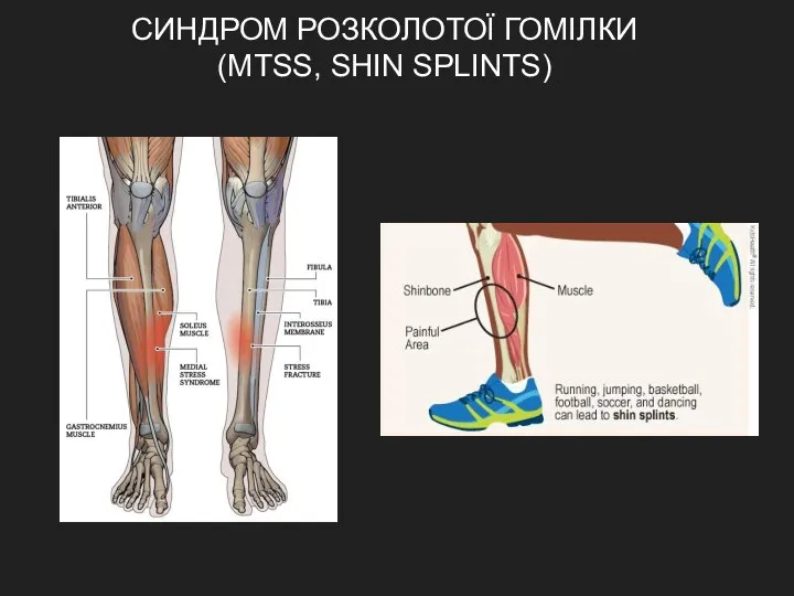 СИНДРОМ РОЗКОЛОТОЇ ГОМІЛКИ (MTSS, SHIN SPLINTS)