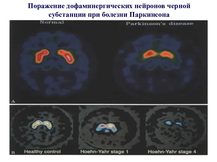Поражение дофаминергических нейронов черной субстанции при болезни Паркинсона