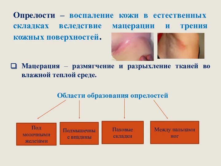 Опрелости – воспаление кожи в естественных складках вследствие мацерации и