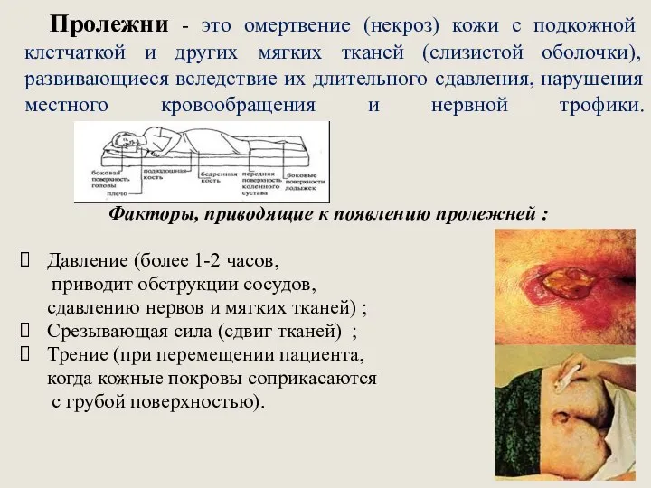 Пролежни - это омертвение (некроз) кожи с подкожной клетчаткой и