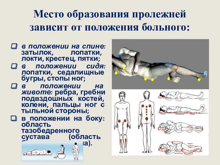 Место образования пролежней зависит от положения больного: в положении на