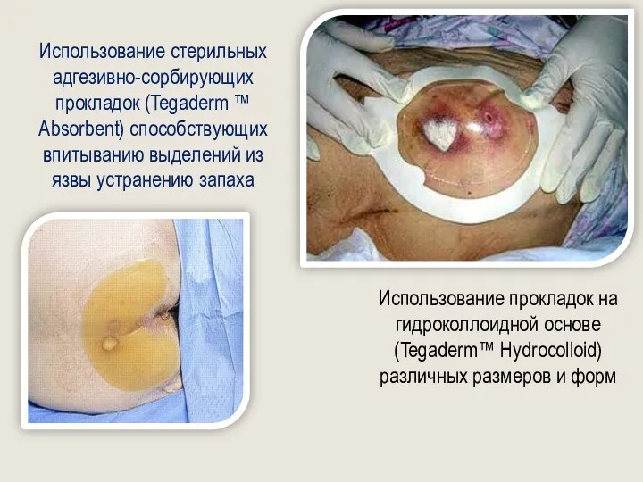 Использование прокладок на гидроколлоидной основе (Tegaderm™ Hydrocolloid) различных размеров и