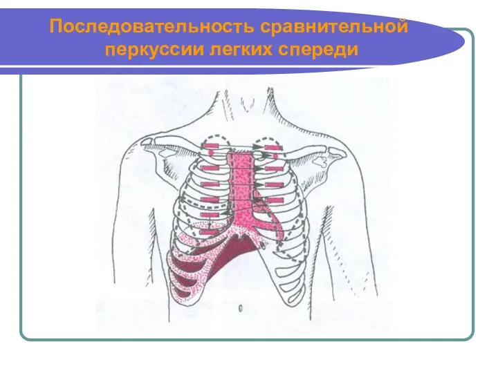 Последовательность сравнительной перкуссии легких спереди