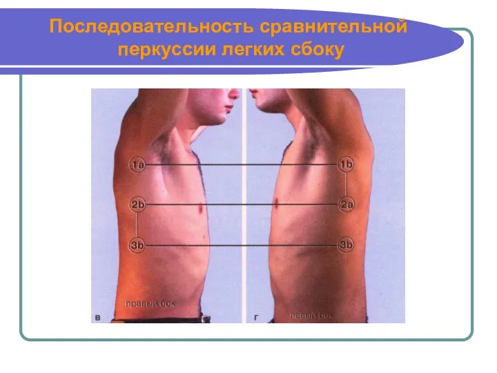 Последовательность сравнительной перкуссии легких сбоку