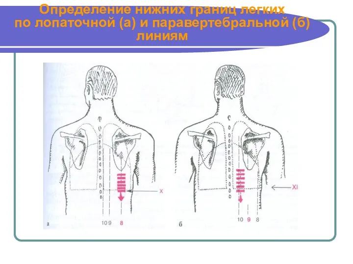 Определение нижних границ легких по лопаточной (а) и паравертебральной (б) линиям