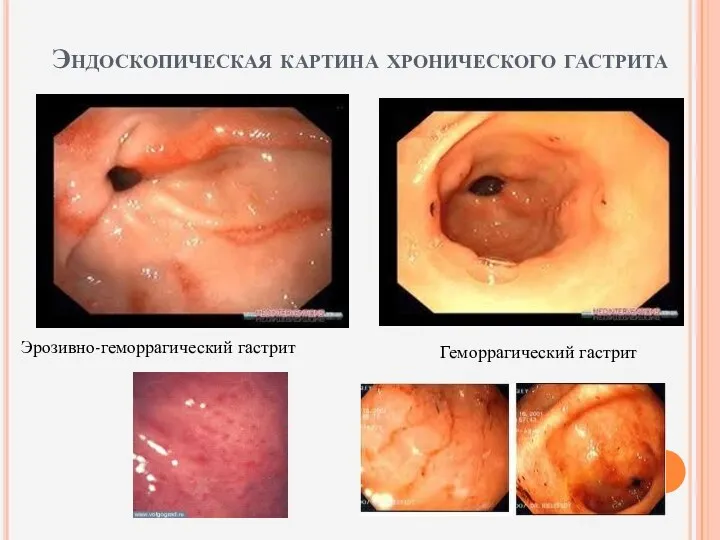 Эндоскопическая картина хронического гастрита Эрозивно-геморрагический гастрит Геморрагический гастрит