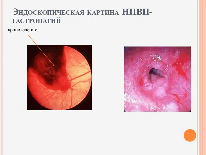 Эндоскопическая картина НПВП-гастропатий кровотечение