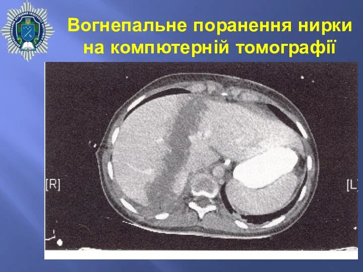 Вогнепальне поранення нирки на компютерній томографії