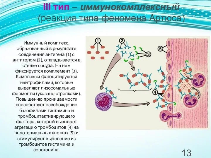 III тип – иммунокомплексный (реакция типа феномена Артюса) Иммунный комплекс,