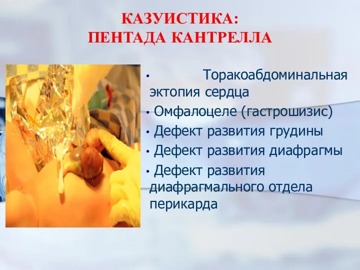 КАЗУИСТИКА: ПЕНТАДА КАНТРЕЛЛА Торакоабдоминальная эктопия сердца Омфалоцеле (гастрошизис) Дефект развития грудины Дефект развития