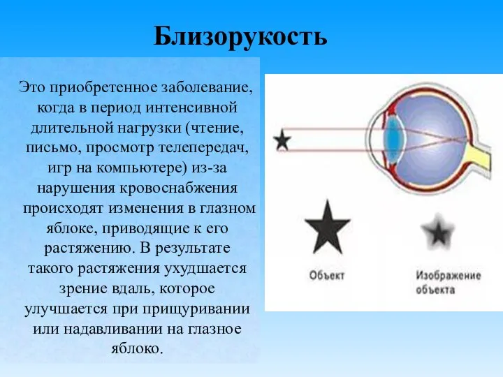 Близорукость Это приобретенное заболевание, когда в период интенсивной длительной нагрузки