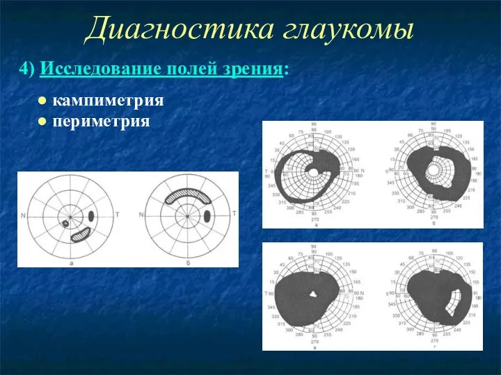 Диагностика глаукомы 4) Исследование полей зрения: ● кампиметрия ● периметрия