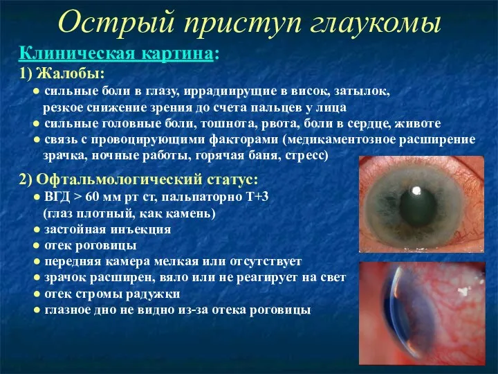 Острый приступ глаукомы Клиническая картина: 1) Жалобы: ● сильные боли в глазу, иррадиирущие