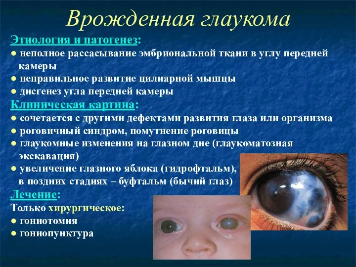 Врожденная глаукома Этиология и патогенез: ● неполное рассасывание эмбриональной ткани в углу передней