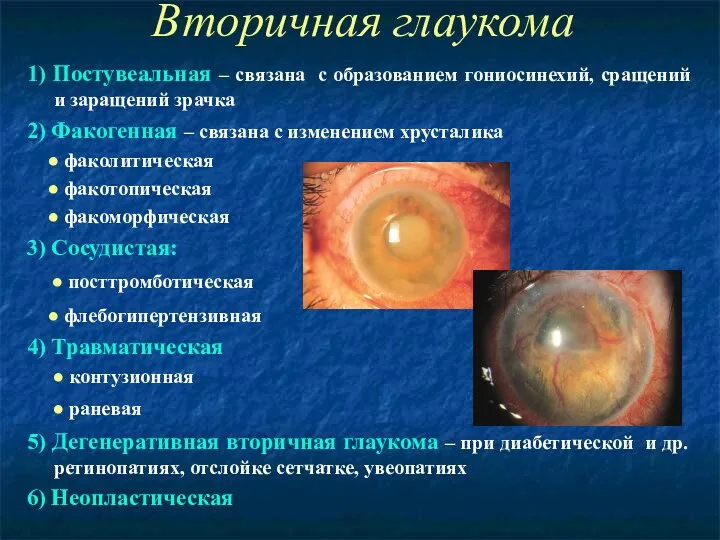 Вторичная глаукома 1) Постувеальная – связана с образованием гониосинехий, сращений и заращений зрачка