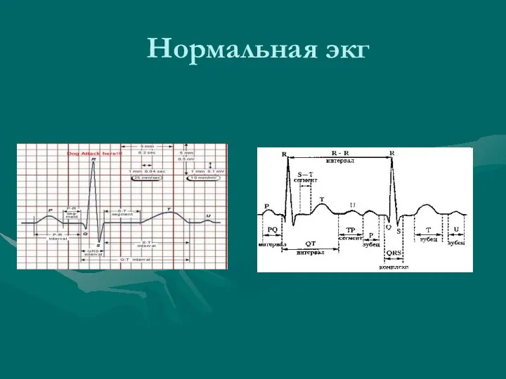 Нормальная экг