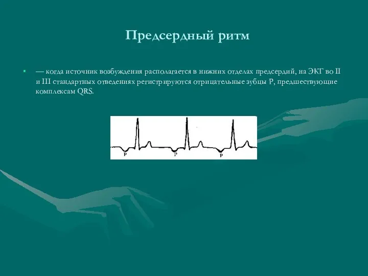 Предсердный ритм — когда источник возбуждения располагается в нижних отделах