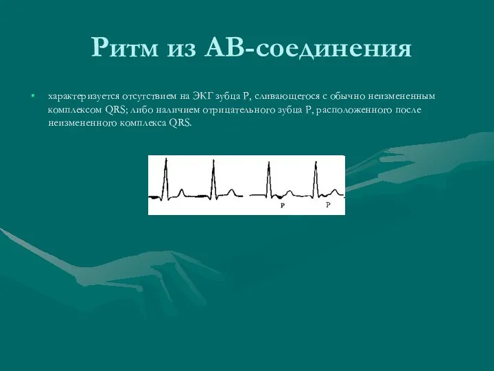 Ритм из АВ-соединения характеризуется отсутствием на ЭКГ зубца Р, сливающегося