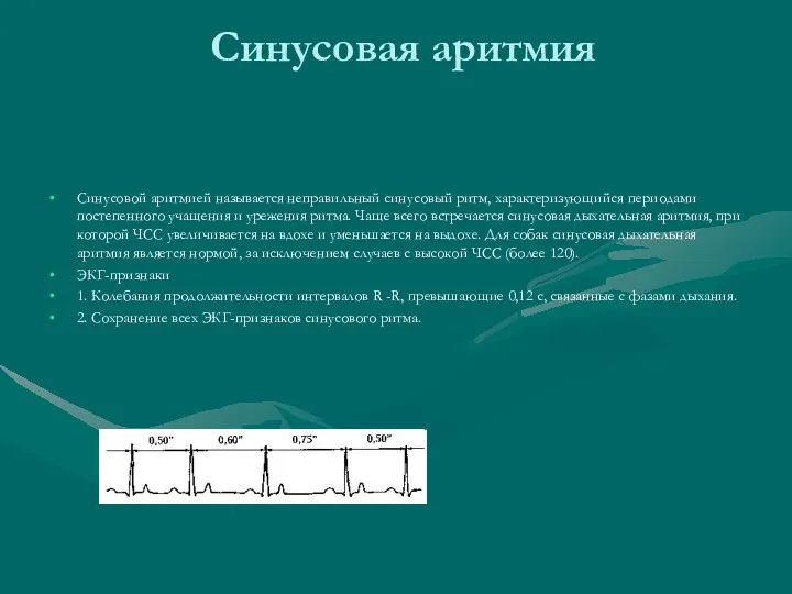 Синусовая аритмия Синусовой аритмией называется неправильный синусовый ритм, характеризующийся периодами