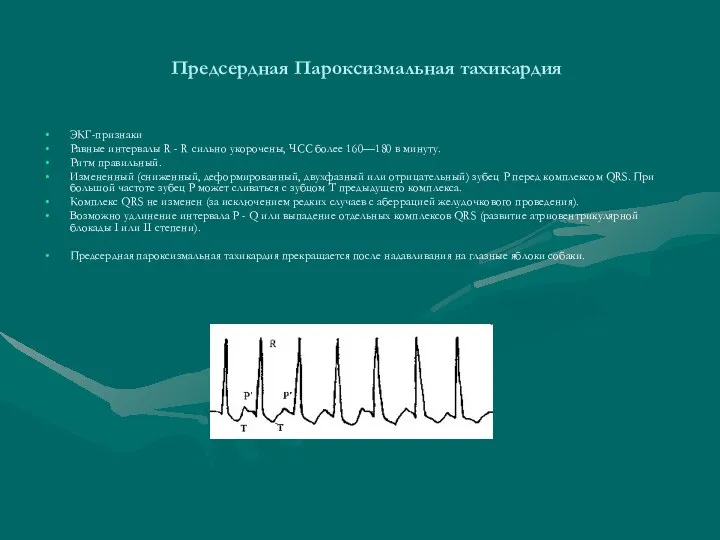 Предсердная Пароксизмальная тахикардия ЭКГ-признаки Равные интервалы R - R сильно