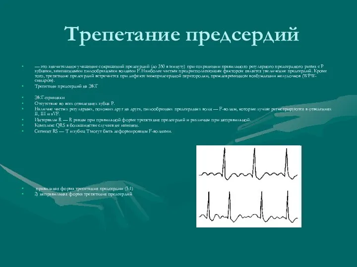 Трепетание предсердий — это значительное учащение сокращений предсердий (до 350