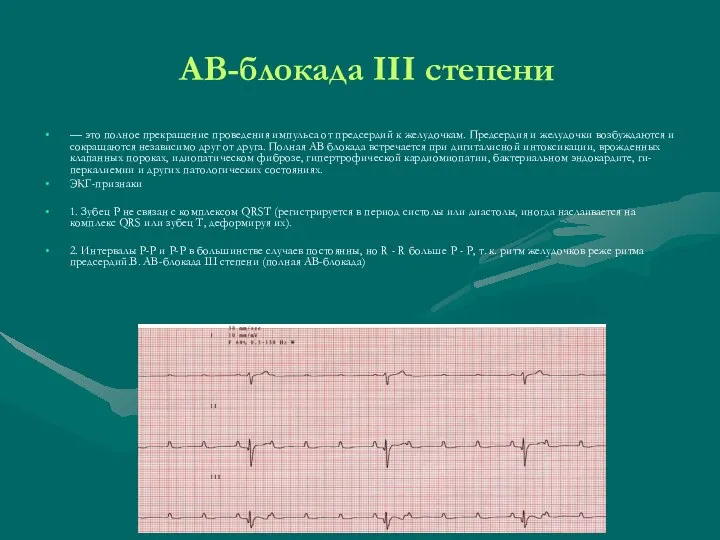 АВ-блокада III степени — это полное прекращение проведения импульса от