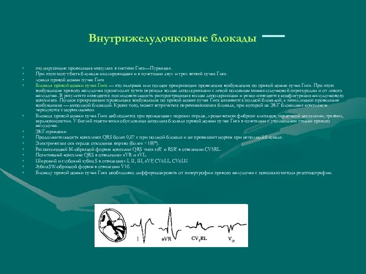 Внутрижелудочковые блокады — это нарушение проведения импульса в системе Гиса—Пуркинье.