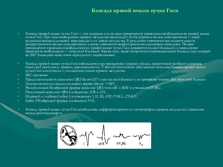 Блокада правой ножки пучка Гиса Блокада правой ножки пучка Гиса