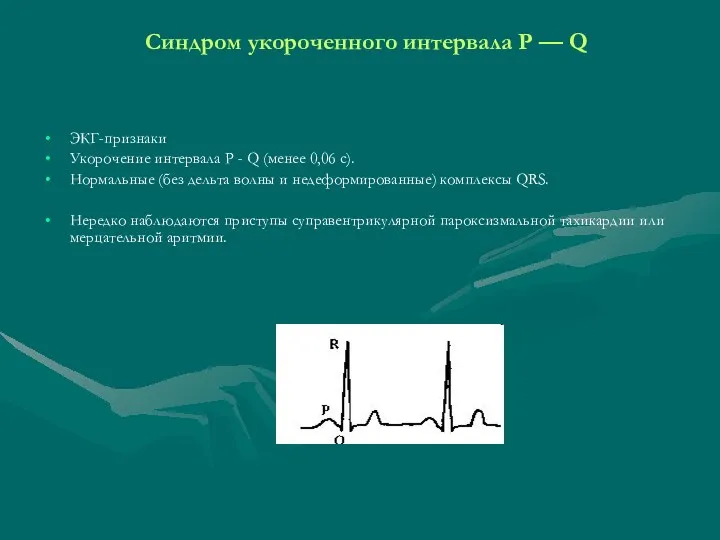 Синдром укороченного интервала Р — Q ЭКГ-признаки Укорочение интервала Р