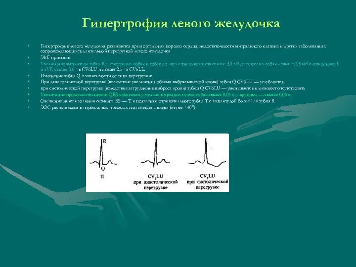 Гипертрофия левого желудочка Гипертрофия левого желудочка развивается при аортальных пороках