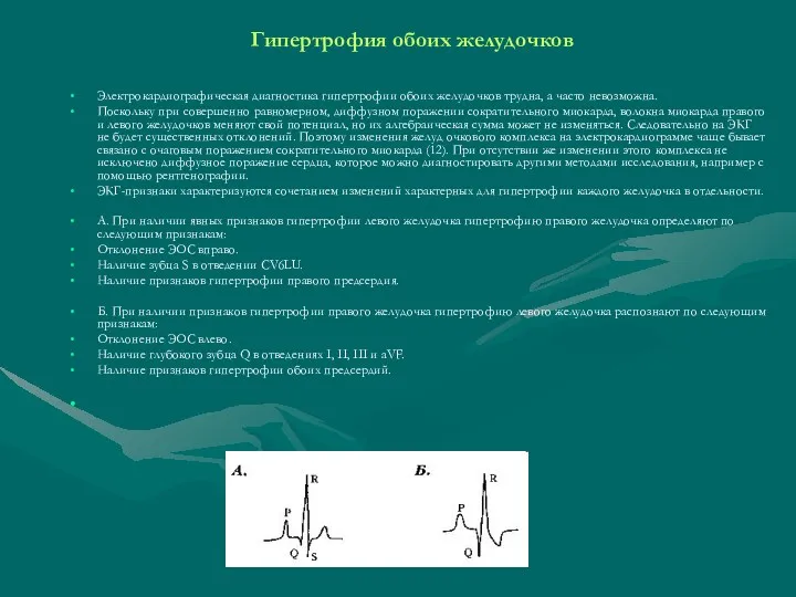 Гипертрофия обоих желудочков Электрокардиографическая диагностика гипертрофии обоих желудочков трудна, а