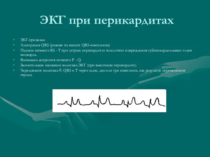 ЭКГ при перикардитах ЭКГ-признаки Альтерация QRS (разные по высоте QRS-комплексы)