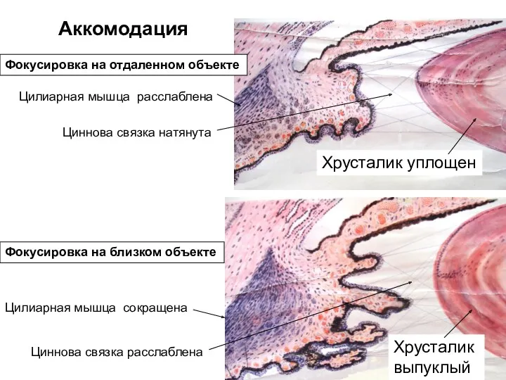 Аккомодация Цилиарная мышца расслаблена Циннова связка натянута Хрусталик уплощен Фокусировка