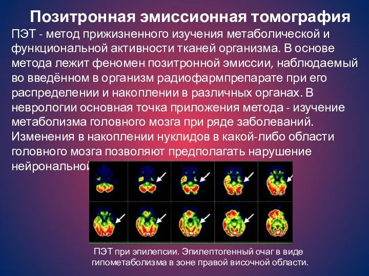 Позитронная эмиссионная томография ПЭТ - метод прижизненного изучения метаболической и функциональной активности тканей