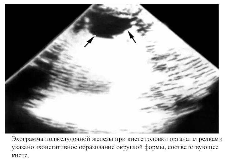 Эхограмма поджелудочной железы при кисте головки органа: стрелками указано эхонегативное образование округлой формы, соответствующее кисте.