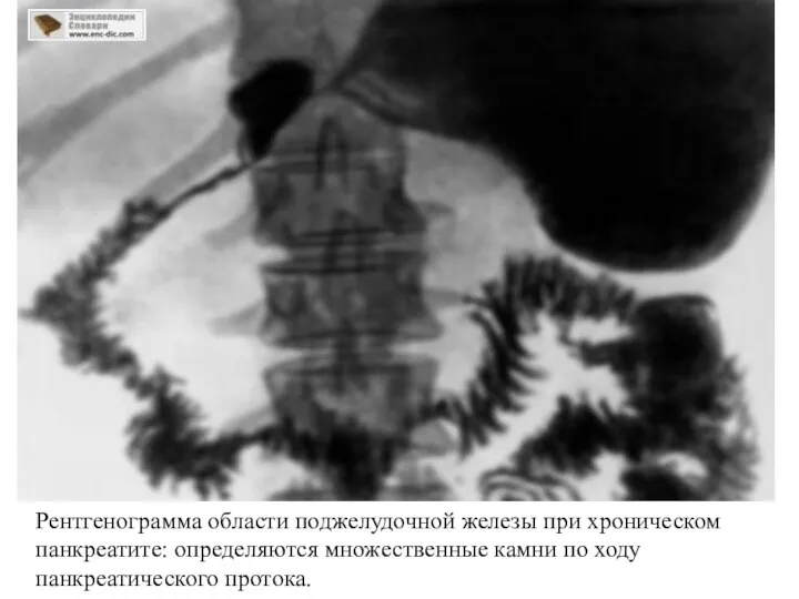 Рентгенограмма области поджелудочной железы при хроническом панкреатите: определяются множественные камни по ходу панкреатического протока.