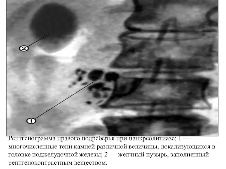 Рентгенограмма правого подреберья при панкреолитиазе: 1 — многочисленные тени камней различной величины, локализующихся