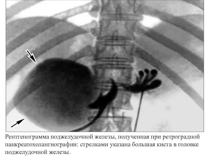 Рентгенограмма поджелудочной железы, полученная при ретроградной панкреатохолангиографии: стрелками указана большая киста в головке поджелудочной железы.