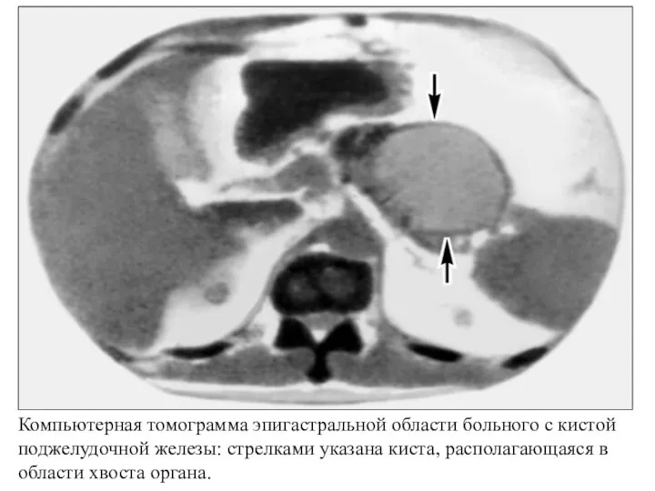 Компьютерная томограмма эпигастральной области больного с кистой поджелудочной железы: стрелками указана киста, располагающаяся
