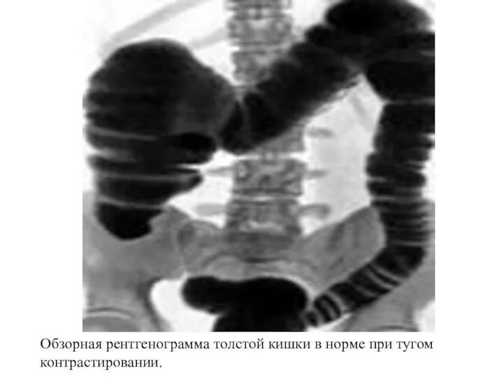 Обзорная рентгенограмма толстой кишки в норме при тугом контрастировании.