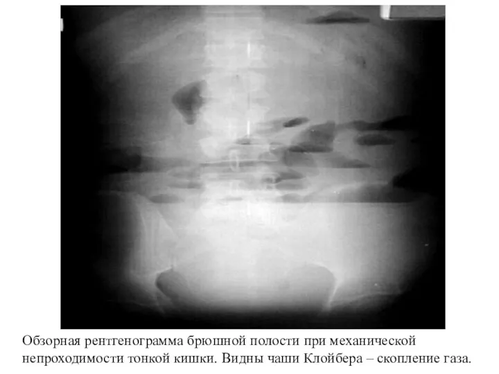 Обзорная рентгенограмма брюшной полости при механической непроходимости тонкой кишки. Видны чаши Клойбера – скопление газа.