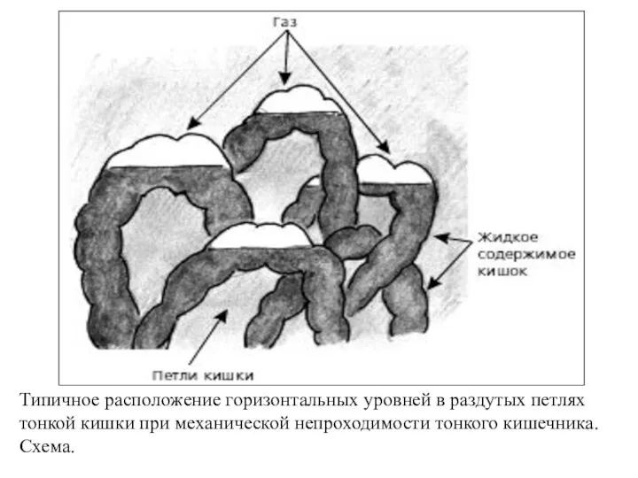 Типичное расположение горизонтальных уровней в раздутых петлях тонкой кишки при механической непроходимости тонкого кишечника. Схема.