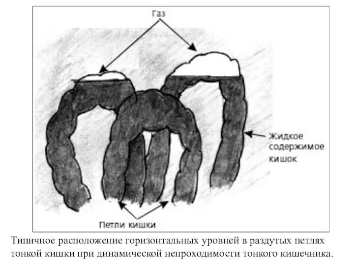 Типичное расположение горизонтальных уровней в раздутых петлях тонкой кишки при динамической непроходимости тонкого кишечника.